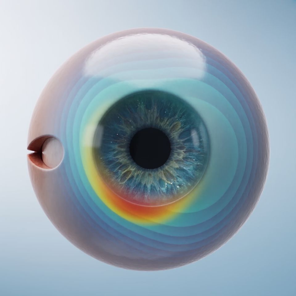 Ilustración tridimensional de un ojo con un mapa de curvatura corneal